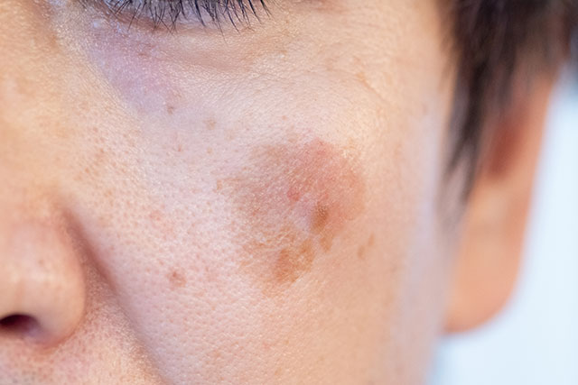 シミ、肝斑、イボ・・・夏の落とし物